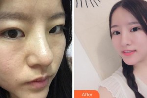 杭州港麗醫(yī)療美容診所劉庭華整形價(jià)格表附切開雙眼皮案例展示