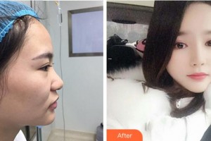 寧波珈禾整形?？漆t(yī)院龔濤整形價(jià)格表附鼻部綜合案例展示