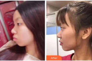 寧波珈禾整形?？漆t(yī)院王昊整形價(jià)格表附金屬托槽矯正案例展示