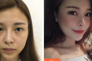 懷化天姿整形美容醫(yī)院吳載源整形價(jià)格表附自體脂肪全臉填充案例展示