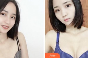 寧波珈禾整形?？漆t(yī)院鄧小榮整形價格表附自體脂肪隆胸案例展示