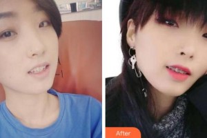 寧波珈禾整形?？漆t(yī)院鮑琴兒整形價格表附金屬托槽矯正案例展示