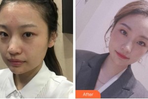 寧波市婦女兒童醫(yī)院醫(yī)學(xué)美容科黃應(yīng)整形價格表附激光祛斑案例展示