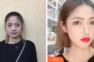 寧波壹加壹美容醫(yī)院元慶植整形價格表附埋線提升案例展示