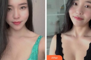 寧波陳標新整形美容醫(yī)院催恒碩整形價格表附自體脂肪隆胸案例展示