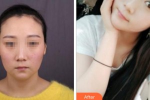 寧波陳標新整形美容醫(yī)院權(quán)鏞頊整形價格表附埋線提升案例展示