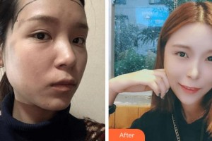 寧波陳標新整形美容醫(yī)院金明哲整形價格表附種植發(fā)際線案例展示