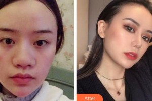 寧波唯格醫(yī)療美容門診部李曉霞整形價(jià)格表附鼻中隔軟骨隆鼻案例展示