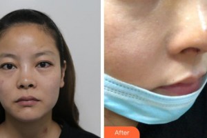 寧波復(fù)大皮膚病?？漆t(yī)院江海鵬整形價(jià)格表附鼻部綜合案例展示