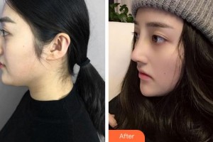 寧波韓美醫(yī)療美容門(mén)診部張建波整形價(jià)格表附鼻部綜合案例展示