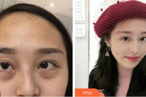 寧波鄞州眼科醫(yī)院周宏健整形價(jià)格表附內(nèi)切祛眼袋案例展示
