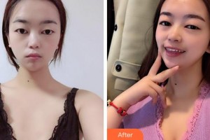 溫州雅美姬整形美容醫(yī)院王公望整形價(jià)格表附自體脂肪隆胸案例展示