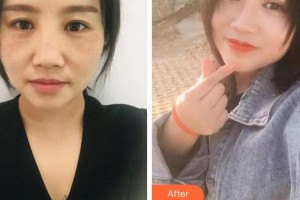 溫州韓美整形美容醫(yī)院紀(jì)強整形價格表附眼部綜合案例展示