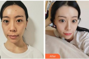 嘉興禾美醫(yī)療美容醫(yī)院趙學(xué)燕整形價格表附埋線提升案例展示
