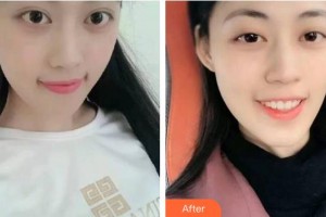湖州鼎植口腔醫(yī)院聞香禎整形價(jià)格表附冷光美白案例展示