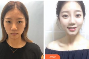 湖州市中心醫(yī)院眼科邱海雁整形價(jià)格表附眼部綜合案例展示