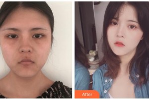 紹興華美整形美容醫(yī)院葉品英整形價(jià)格表附埋線(xiàn)提升案例展示