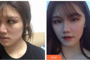 紹興華美整形美容醫(yī)院張潔整形價(jià)格表附埋線(xiàn)提升案例展示