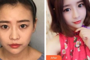 紹興華美整形美容醫(yī)院錢(qián)一佳整形價(jià)格表附熱瑪吉案例展示