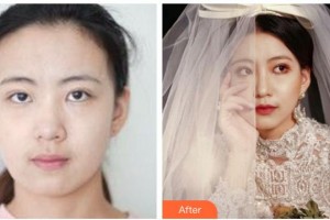 紹興華美整形美容醫(yī)院徐榮俊整形價(jià)格表附熱瑪吉案例展示