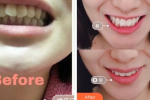 紹興德維口腔醫(yī)院張濤整形價(jià)格表附牙齒隱形矯正案例展示