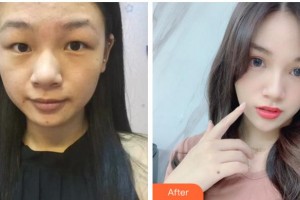 紹興愛爾眼科醫(yī)院梁麗瓊整形價(jià)格表附切開雙眼皮案例展示