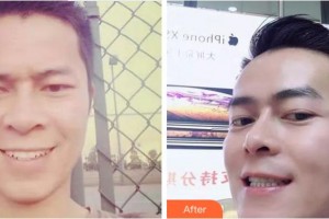 紹興市口腔醫(yī)院馮偉整形價格表附金屬托槽矯正案例展示