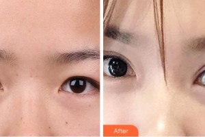 金華芘麗芙（原華美）整形醫(yī)院吳朔凡整形價(jià)格表附切開雙眼皮案例展示