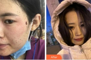 金華美辰醫(yī)療美容醫(yī)院徐伶愛整形價(jià)格表附激光美膚激光案例展示