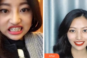 金華口腔醫(yī)院李倩整形價格表附美白貼片案例展示