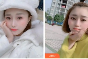 金華口腔醫(yī)院方麗整形價格表附金屬托槽矯正案例展示