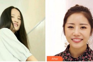 衢州口腔醫(yī)院李婉整形價格表附牙齒隱形矯正案例展示