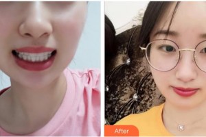 臺州維多利亞整形美容醫(yī)院于文學(xué)整形價格表附牙齒隱形矯正案例展示