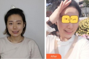 臺州維多利亞整形美容醫(yī)院藍(lán)海慧整形價格表附牙齒隱形矯正案例展示