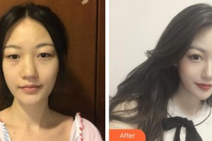 臺州廣濟整形美容醫(yī)院逯聯(lián)合整形價格表附鼻部綜合案例展示