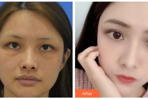 臺(tái)州愛美美萊醫(yī)療美容門診部金潔整形價(jià)格表附埋線提升案例展示
