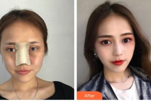 臺(tái)州愛美美萊醫(yī)療美容門診部王俊整形價(jià)格表附鼻部綜合案例展示
