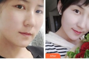 臺(tái)州愛美美萊醫(yī)療美容門診部林怡欣整形價(jià)格表附埋線提升案例展示