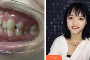 臺(tái)州貝雅口腔醫(yī)院徐仙龍整形價(jià)格表附金屬托槽矯正案例展示