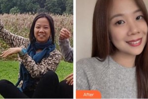 臺(tái)州貝雅口腔醫(yī)院羅剛整形價(jià)格表附金屬托槽矯正案例展示