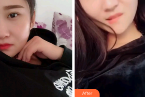 深圳銘醫(yī)醫(yī)療美容醫(yī)院于秀英整形價格表附根管調節(jié)案例展示