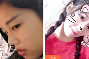 深圳悅己醫(yī)療美容醫(yī)院劉學鋒整形價格表附鼻部手術案例展示