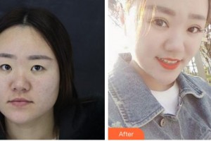 臺州國際眼科醫(yī)院許梅萍整形價格表附切開雙眼皮案例展示