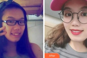 臺州康貝佳口腔醫(yī)院李恒德整形價格表附隱形托槽矯正案例展示