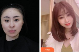 麗水思齊整形外科門診部蔣茂奇整形價格表附膠原蛋白除皺案例展示