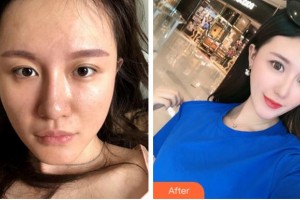 四川西嬋整形美容醫(yī)院劉玉峰教授 美容皮膚顧問整形價格表附埋線提升案例展示