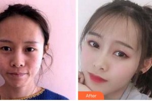 四川美萊醫(yī)學美容醫(yī)院韓國棟整形價格表附埋線提升案例展示