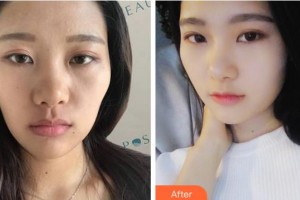 四川美萊醫(yī)學美容醫(yī)院宋奉宜整形價格表附熱瑪吉案例展示