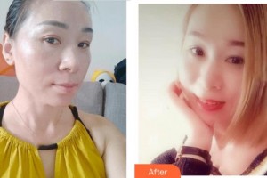 四川華美紫馨醫(yī)學美容醫(yī)院趙瓊英整形價格表附激光祛斑案例展示