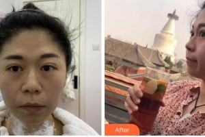 四川華美紫馨醫(yī)學美容醫(yī)院郁梅整形價格表附熱瑪吉案例展示